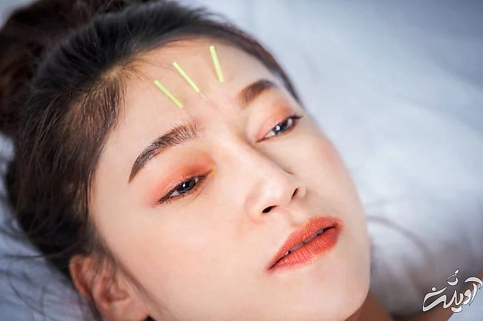 روشن شدن پوست با طب سوزنی طب سوزنی صورت